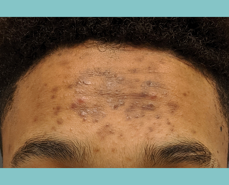 Aerolase Laser Treatment Before and After | Comprehensive Laser & Aesthetics