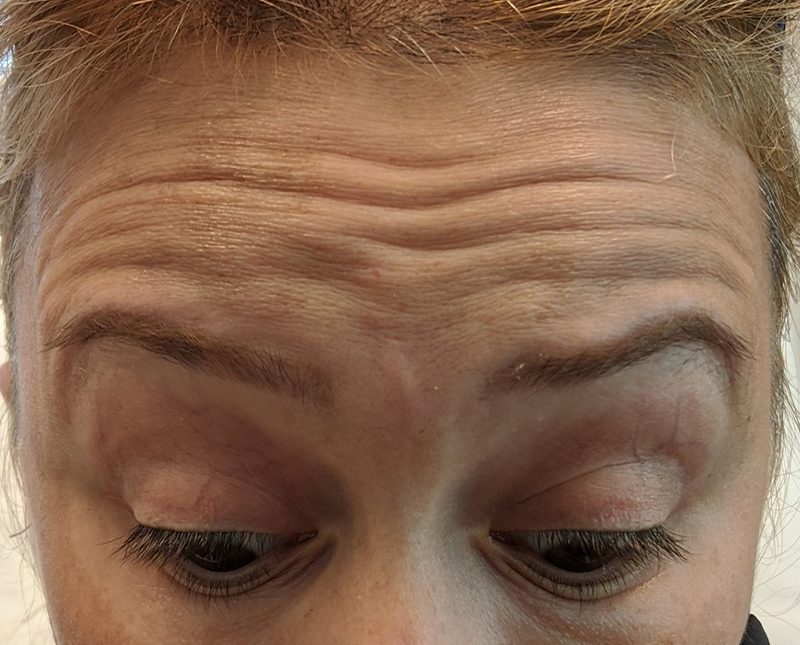 Botox Dysport Before and After | Comprehensive Laser & Aesthetics