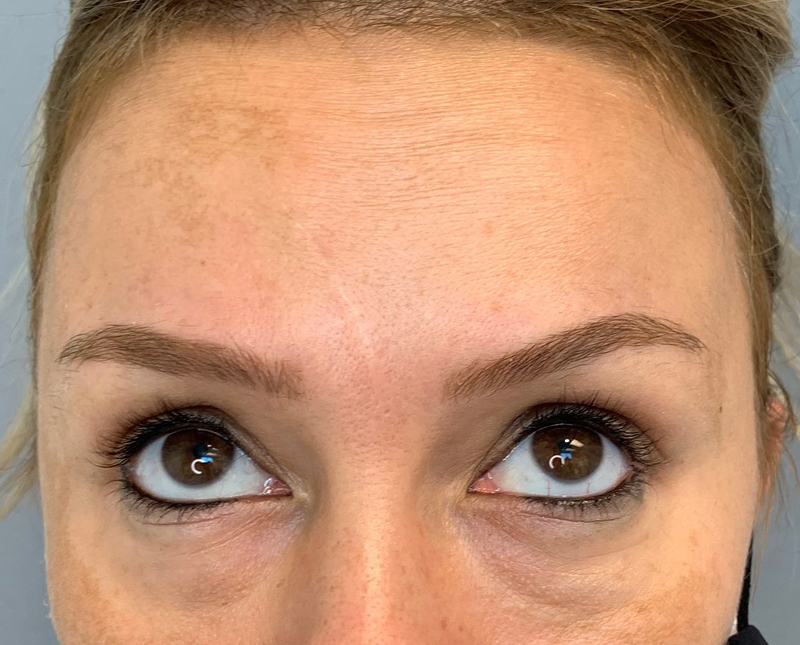 Botox Dysport Before and After | Comprehensive Laser & Aesthetics