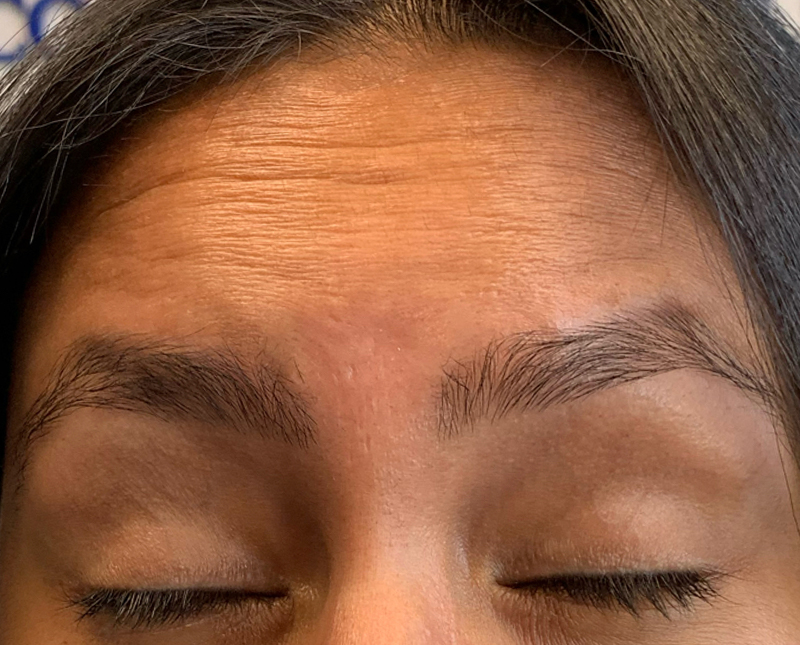 Botox Dysport Before and After | Comprehensive Laser & Aesthetics