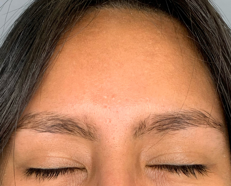 Botox Dysport Before and After | Comprehensive Laser & Aesthetics