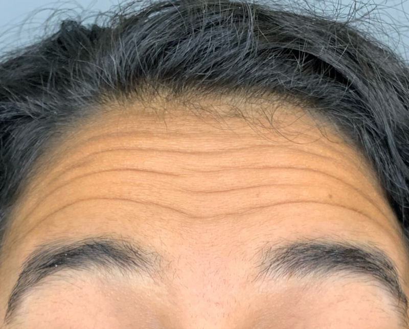 Botox Dysport Before and After | Comprehensive Laser & Aesthetics