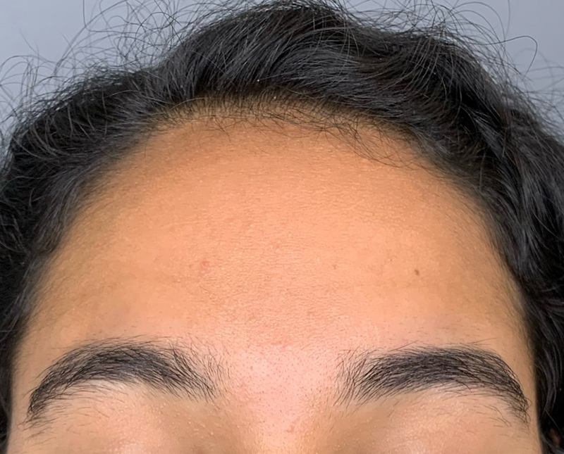 Botox Dysport Before and After | Comprehensive Laser & Aesthetics