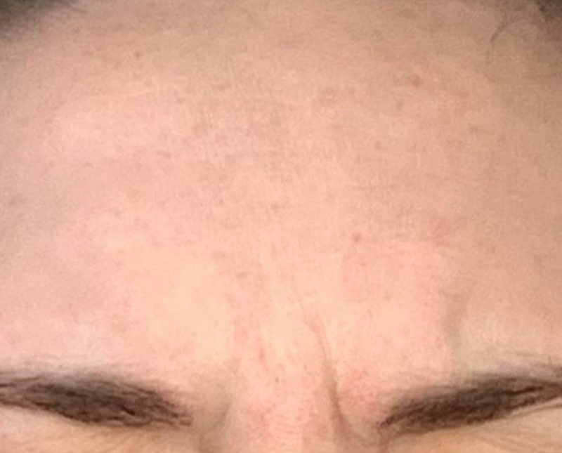 Botox Dysport Before and After | Comprehensive Laser & Aesthetics