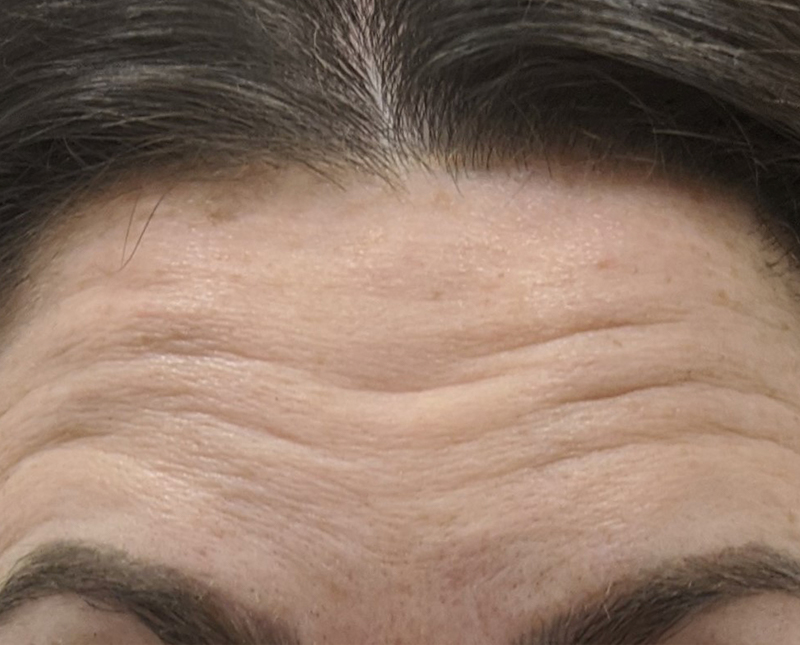 Botox Dysport Before and After | Comprehensive Laser & Aesthetics