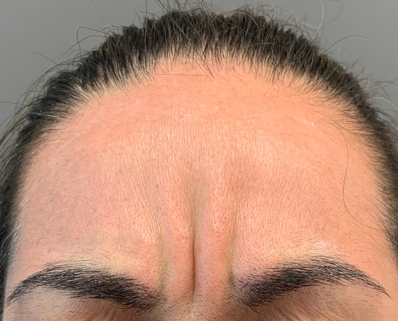 Botox Dysport Before and After | Comprehensive Laser & Aesthetics