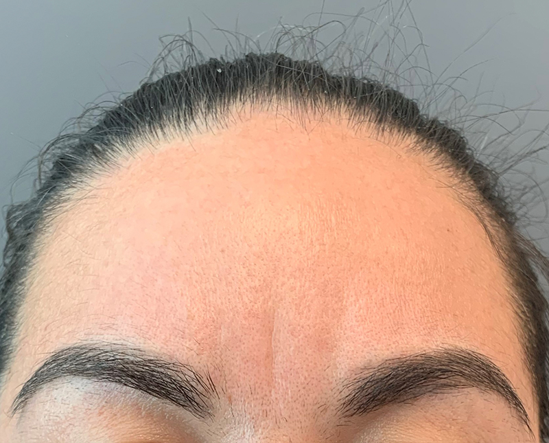 Botox Dysport Before and After | Comprehensive Laser & Aesthetics