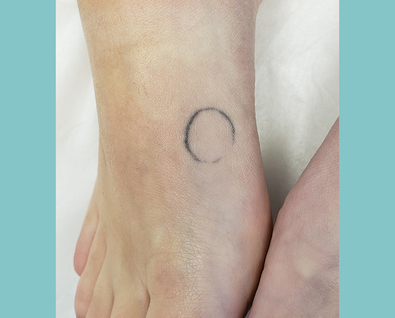 Laser Tattoo Removal Before and After | Comprehensive Laser & Aesthetics