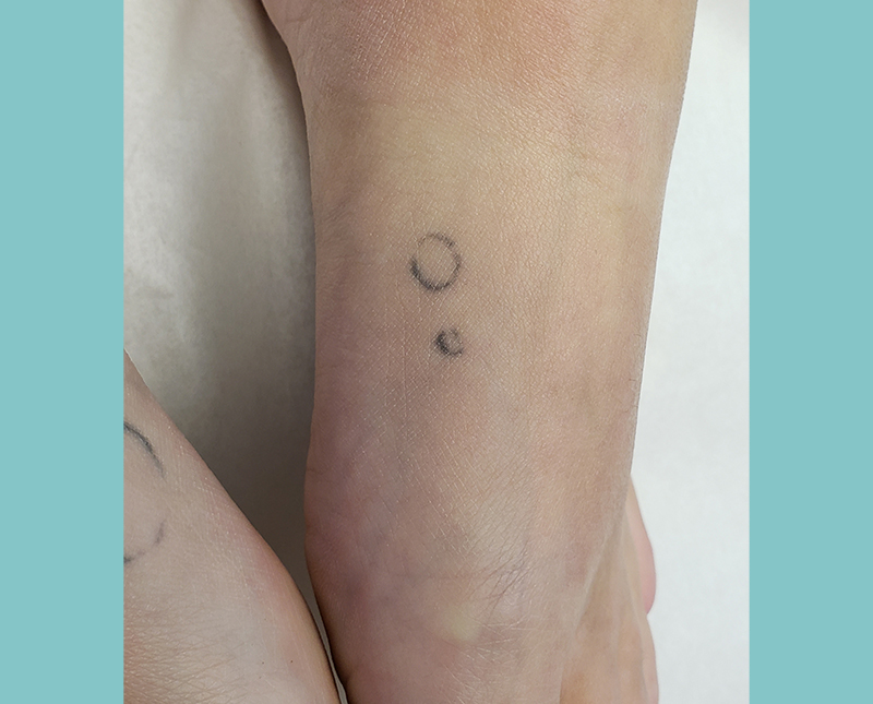 Laser Tattoo Removal Before and After | Comprehensive Laser & Aesthetics