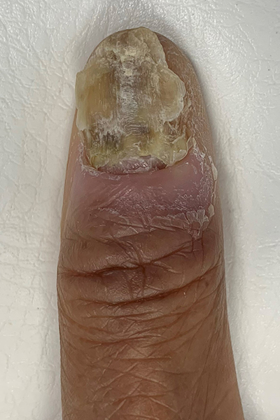 Nail Fungus Before and After | Comprehensive Laser & Aesthetics