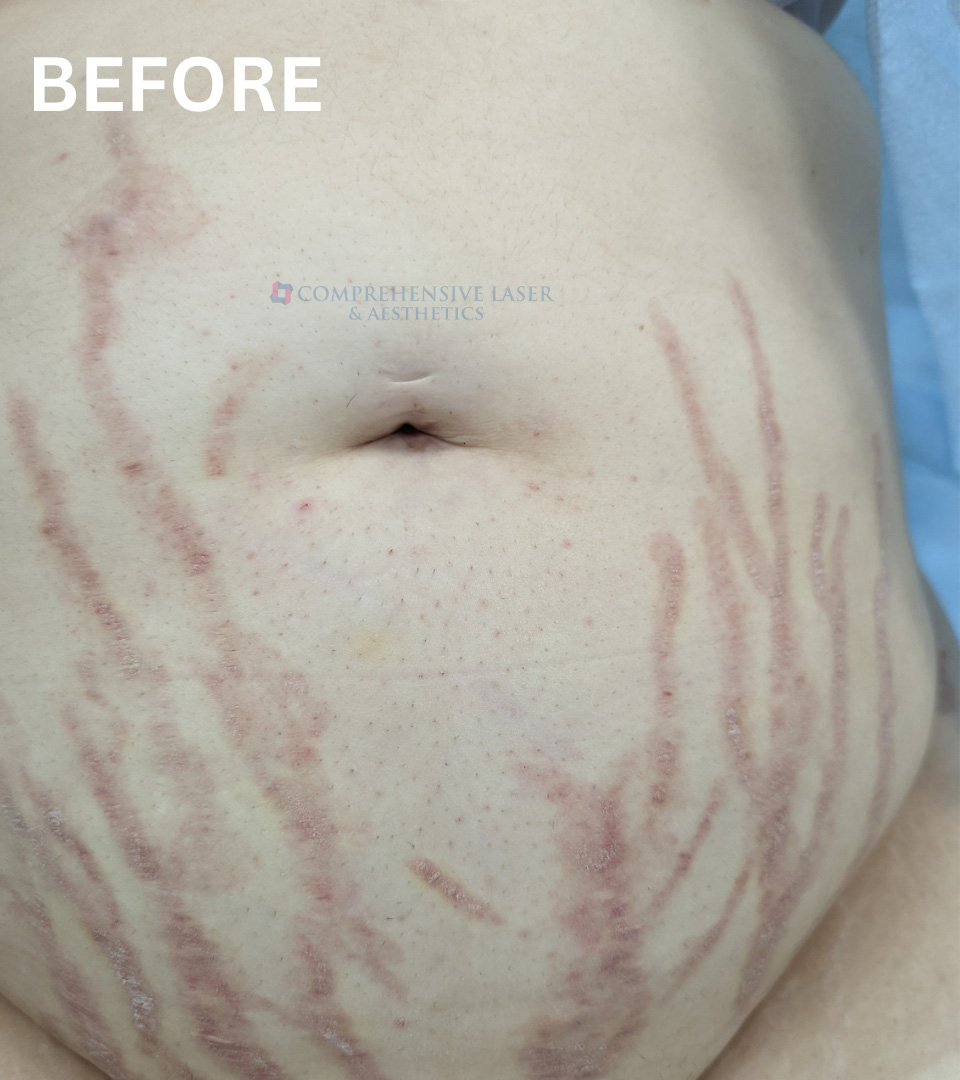 Stretch Marks Before and After | Comprehensive Laser & Aesthetics