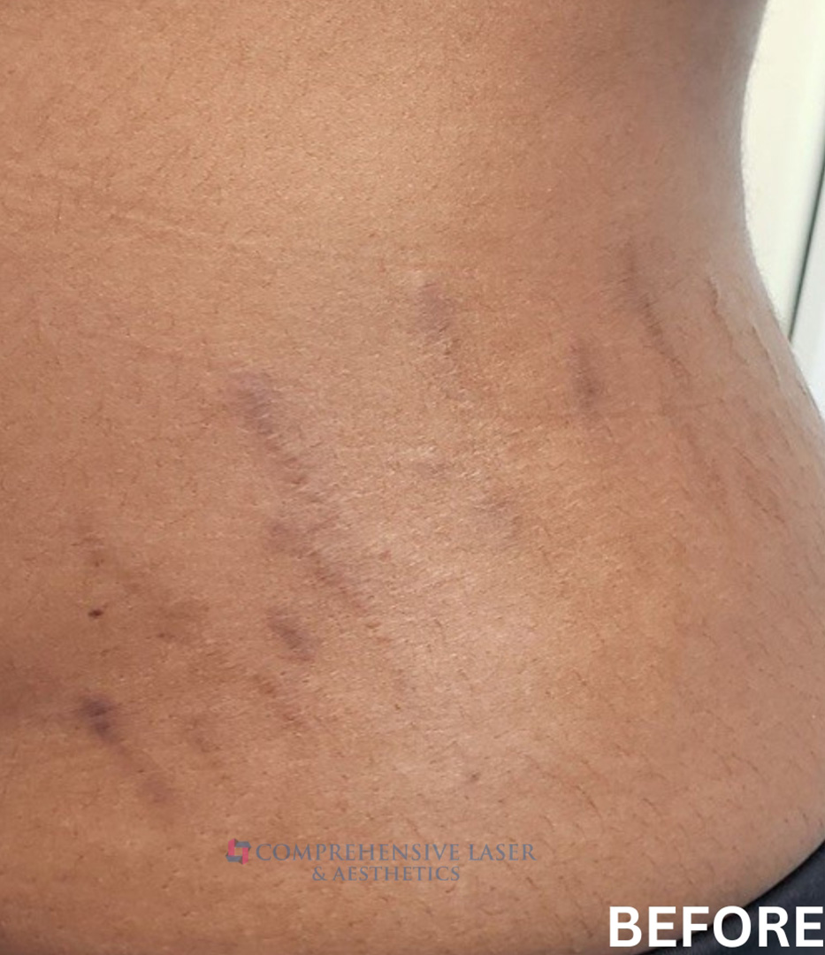 Stretch Marks Before and After | Comprehensive Laser & Aesthetics