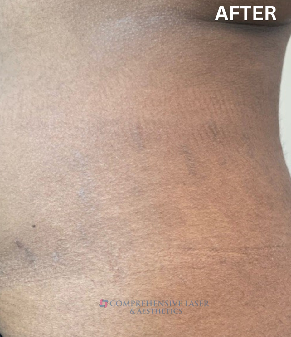 Stretch Marks Before and After | Comprehensive Laser & Aesthetics