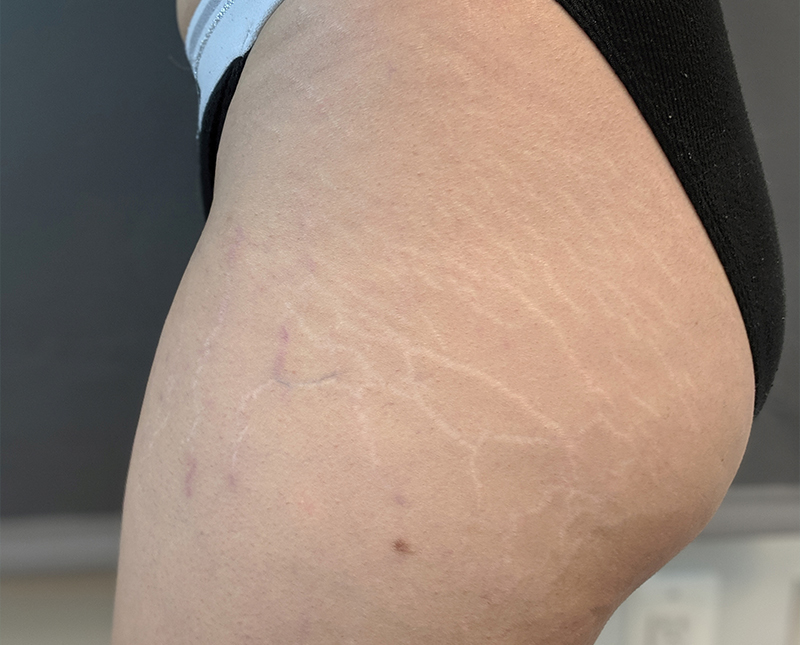 Stretch Marks Before and After | Comprehensive Laser & Aesthetics