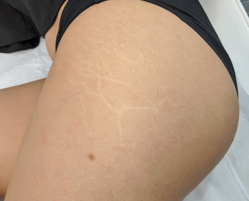 Stretch Marks Before and After | Comprehensive Laser & Aesthetics