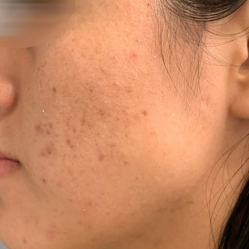 Vi Peel Before and After | Comprehensive Laser & Aesthetics