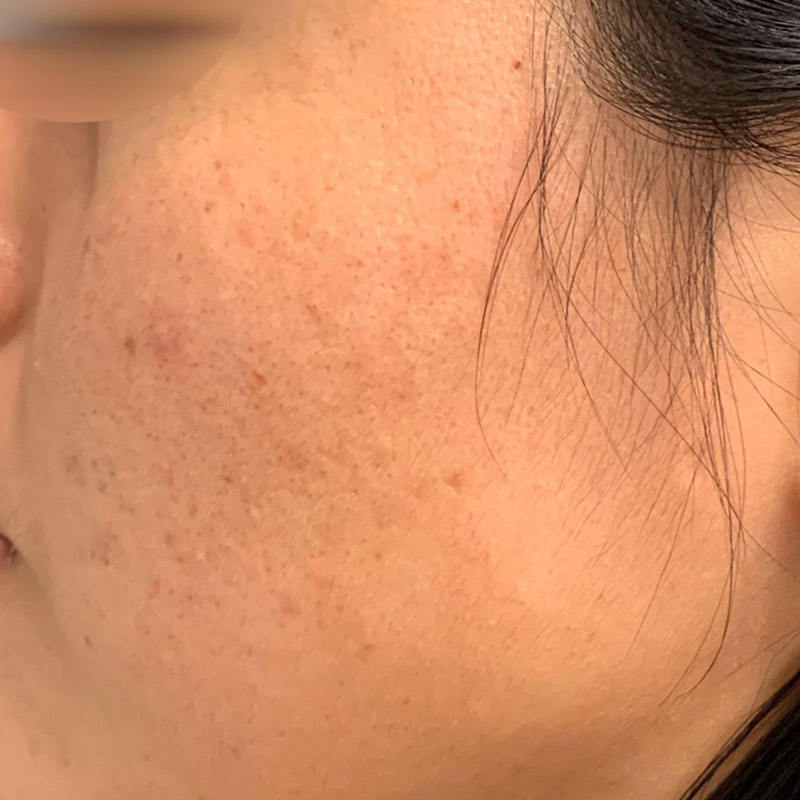 Vi Peel Before and After | Comprehensive Laser & Aesthetics