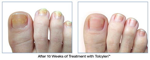 toenail fungus before and after